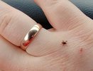 В Костромской области выявили второй случай клещевого боррелиоза