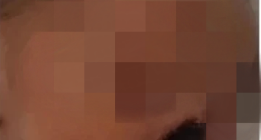 Костромская больница заплатит за отпавший нос новорожденной девочки лишь два миллиона