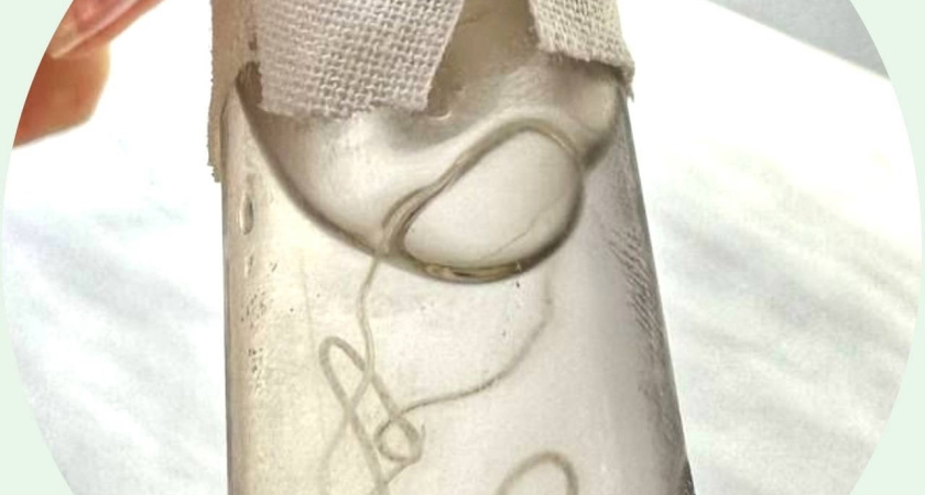 У костромички в глазу обнаружили паразита, длиной 10 сантиметров