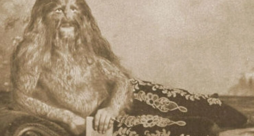 Мать назвала "мерзостью", а приемный отец показывал в цирке: как сложилась судьба "мальчика с львиным лицом"