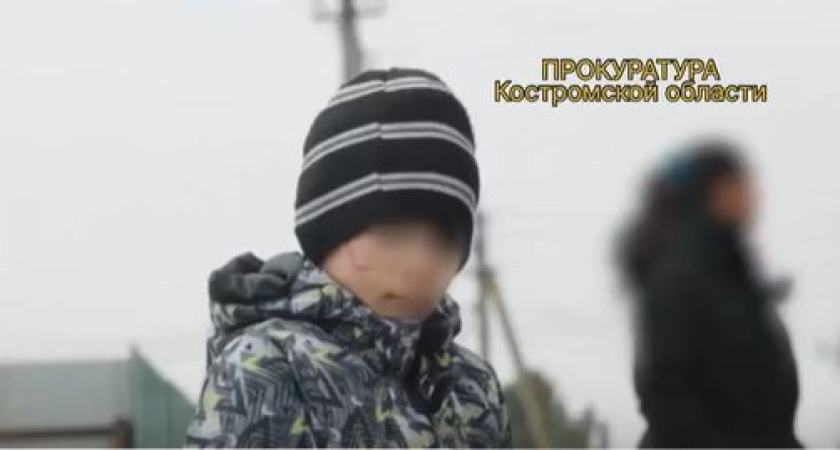 В Костроме хозяин собаки заплатит 300 тысяч за изуродованное лицо ребенка